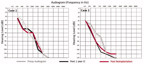Figure 26. Pure-tone audiometry results of case 1 (child) and case 2 (adult) with pre-op (grey line), post-1-year CI (black line) and post-re-implantation (red line) audiogram results [Citation21]. Reproduced by permission of Wolters Kluwer Health, Inc.