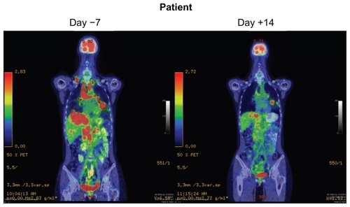 Figure 3 Dramatic response to crizotinib in a ALK-rearranged NSCLC patient.