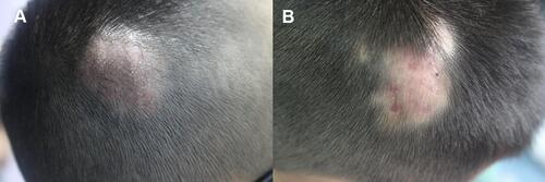 Figure 4 (A) Clinical manifestation of patient 4. (B) Complete remission after treatment of patient 4.