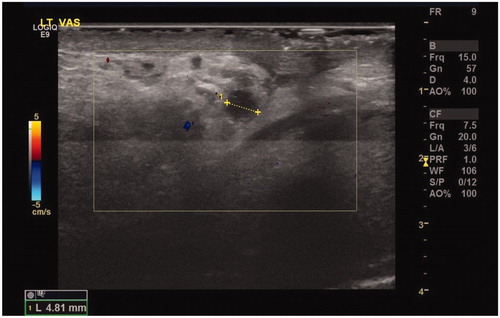 Figure 2. USS image reporting left acute vasitis.