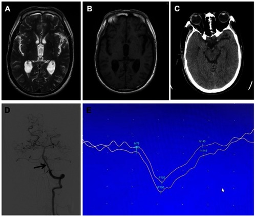 Figure 1 Imaging of skull and vascularity. No abnormalities of occipital lobe were identified on (A) MRI, T2, (B) MRI, T1, and (C) CT. (D) Mild vertebral stenosis was shown on the computed tomographic angiography (arrow). (E) Visual evoked potential examination demonstrated a prolonged P100.