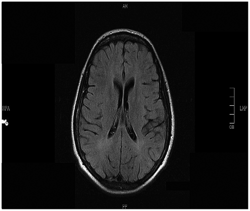 Figure 3: MRI brain at admission shows periventricular white matter hyperintensities.