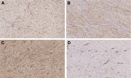 Figure 7 Expression of β-catenin, SMA, vimentin, and CD34 by IHC staining (scale bar =2,000 μm; original × 100).Notes: (A) β-Catenin positive expression can be detected by IHC staining. (B) SMA positive expression can be detected by IHC staining. (D) CD34 positive expression can be detected by IHC staining.