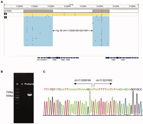Figure 2. Molecular characterization of the 5 kb deletion. (A) Single molecule real-time sequencing analysis of the patient. The light yellow and blue regions indicate the two alleles of the β-globin gene cluster. The arrows indicate the region of the deletion. The blue dots indicate sequencing errors. The relative positions of the HBD, HBB and AC104389.7 genes on chromosome 16 are indicated by blue boxes. The vertical colored lines indicate nucleotides A (green), T (red), C (blue) and G (orange) discordant with alignment to the Hg38 reference sequence. (B) Gap-PCR analysis showing a unique 600 bp product in the proband. M: marker; N: normal control. (C) Sanger sequencing results of the deletion. The arrows indicate the breakpoints of the deletion.