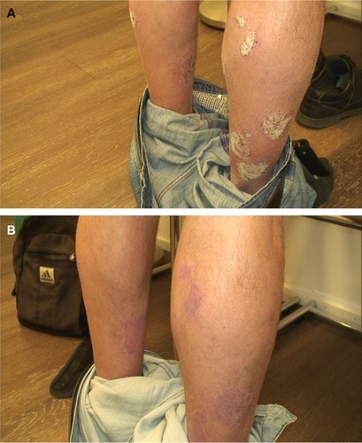 Figure 5 (A) Moderate-to-severe psoriasis in a 56-year-old male before treatment with Cal/BD aerosol foam. (B) Psoriatic lesion after 4 weeks’ treatment with Cal/BD aerosol foam.