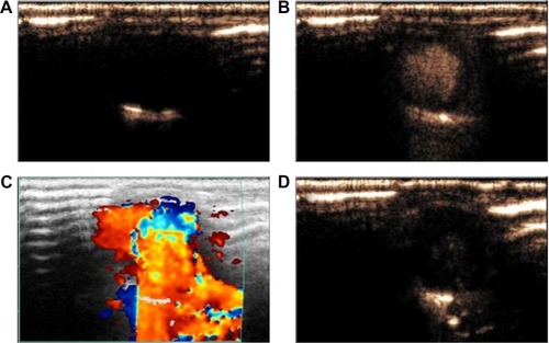 Figure 7 Images captured by the linear array transducer at different stages of the UTMD process.Notes: (A) Ultrasound images before the filling of microbubble agent, following injection; (B) left ventricular myocardium was gradually filled with microbubble agent; (C) targeted bursting of microbubbles by MBD function; (D) ultrasound images after UTMD treatment.Abbreviations: UTMD, ultrasound-targeted microbubble destruction; MBD, microbubble destruction.