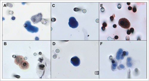 Figure 1. A) Negative control, A-549 cell line “spiked” in healthy blood and negative for EGFR. B) Positive control, FaDu cell line “spiked” in healthy blood and stained for EGFR. C, D) Examples of an isolated CTC of sarcoma patient with cytomorphological features (negative staining for CD45, nucleus size ≥ 12 µm, hyperchromatic and irregular nucleus, visible presence of cytoplasm, and a high nucleus–cytoplasm ratio (Krebs, et al., 2012)Citation15. E) Immunocytochemistry of CTC with anti-EGFR antibody and counterstaining with DAB. F) One CTM from STS patient observed in the blood filtered using the ISET.