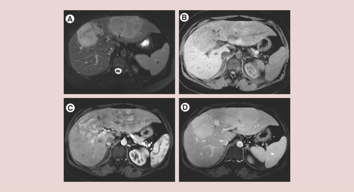 Figure 3. Imaging features of inflammatory hepatocellular adenoma.Two large inflammatory hepatocellular adenomas in a 33-year-old woman. Note: typical MRI appearance with marked hyperintensity on T2-weighted images (A), together with hypointensity on T1-weighted fat-suppressed images (B). After contrast medium injection, there is strong heterogeneous arterial enhancement of the two lesions (C) that persists in the portal venous phase (D).