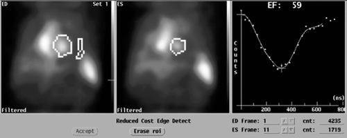 Figure 1.  MUltiple Gated Acquisition (MUGA) scan showing left ventricular ejection fraction (LVEF), end-diastolic (ED) diameter and end-systolic (ES) diameter at baseline.