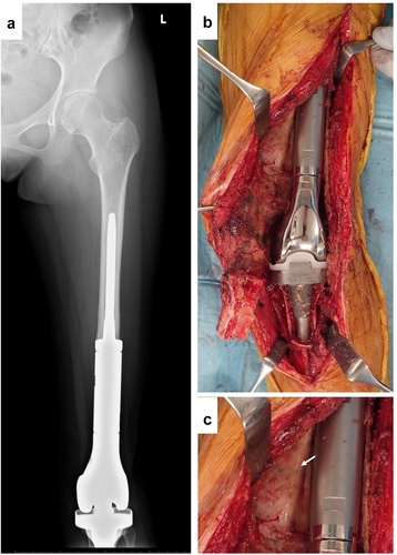 Figure 1. Revision by KMLS (Kyocera Modular Limb Salvage System). (a) X-ray. (b) Intraoperative picture. (c) Soft tissue adjacent to metal surface.