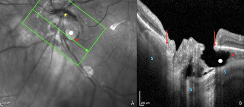 Figure 3 Illustration of a peripapillary intrachoroidal cavitation (PICC) with a full thickness defect. (A) Infra-red image showing a spindle-like tilted disc (yellow star). The green arrow indicates the location of section (B), along the peripapillary area and through gamma peripapillary atrophy (= conus), a full-thickness defect (white dot) and the PICC (red star). (B) Linear OCT section along the green arrow in the infra-red image. The full-thickness defect (white dot) is identified as an area showing disappearance of the inner layers of the retina at the PICC-conus junction. Gamma peripapillary atrophy (between the red arrows) is the peripapillary zone devoid of Bruch’s membrane. Red arrows = ends of Bruch’s membrane. Red star = PICC. The steep excavation of the conus is emphasized by the curvature of the sclera (S).