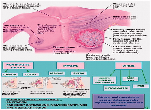 Figure 1. Morphology and medical illustration of the various types of breast cancer.