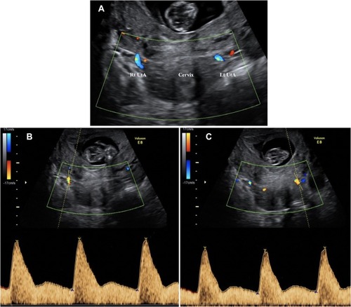 Figure 2 Uterine artery visualized by color Doppler at the level of the internal os using the transverse approach (A) with right (B) and left (C) Doppler measurement waveforms.