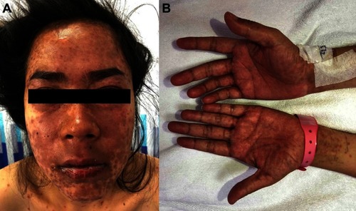 Figure 2 A 25-year-old female patient diagnosed with Stevens–Johnson syndrome–like acute cutaneous lupus erythematosus. (A) Multiple erythematous macules and patches with dusky-red center on the face with crusted erosions, predominantly on the lower lip. (B) Involvement of the palms.