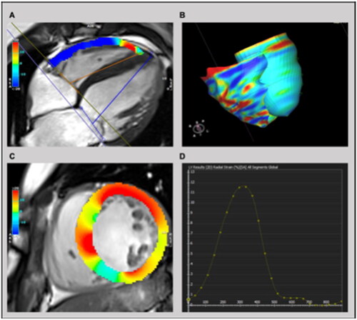 Figure 2. Example of feature tracking strain analysis in a patient with heart failure with reduced ejection fraction. Shown is a colour-coded visualisation of the right ventricular (from reference [Citation20].