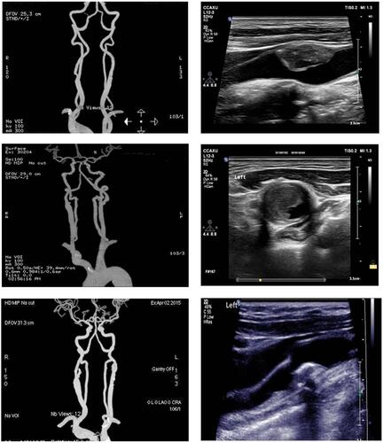 Figure 1 Image of irregular surface and calcification of carotid plaque for enrolled smokers and non-smokers, including CT scanning (left panel) and ultrasonography (right panel).