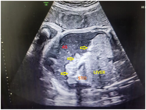 Figure 1. Intraperitoneal calcification in a prenatal ultrasound scan. AS: ascites; STO: stomach. The bold arrows indicate calcification on the surface of the liver and intestines.