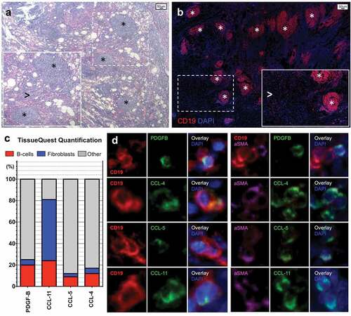 Figure 3. B-lymphocytes and fibroblasts infiltrating pancreatic adenocarcinoma express PDGF-B, CCL-4, CCL-5, and CCL-11.