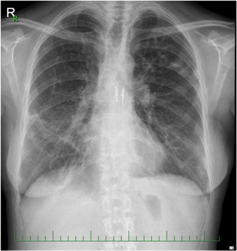 Figure 5 Chest X-rays, 1 year following DLTx.