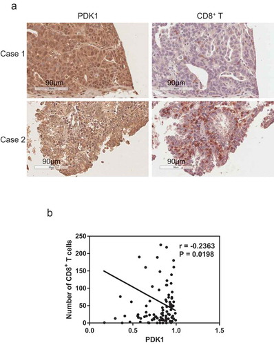 Figure 8. Expression of PDK1 in ovarian cancer is negatively correlated with CD8+ T cell infiltration. (a) Representative immunohistochemical staining image of PDK1 (left panel) and CD8+ T cells (right panel) in ovarian cancer tissue. (b) Spearman’s rho analysis of PDK1 staining density in relation to the number of CD8+ T cells in ovarian cancer. PDK1 staining density was calculated using Image Scope software and CD8+ T cell numbers counted manually.