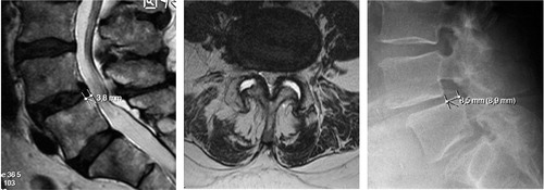Figure 10. On the supine sagittal MRI, the degenerative spondylolisthesis is subtle but on the standing lateral radiograph the slip increases markedly and the disk height decreases simultaneously. Note the fluid signal in the facet joints on the axial MRI indicating potential for pathological segmental movement. The patient had left sided radiating pain, corresponding to the L5 nerve root and reported negligible back pain.