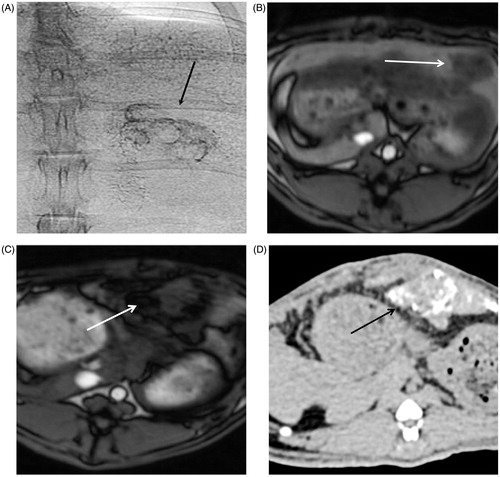 Figure 4. Representative X-ray (CT) and magnetic resonance (MR) images of rabbit liver and VX2 tumours. (A) Single-shot image of rabbit abdominal region during angiography injection of BNF-lip. (B) Axial T1 image of liver VX2 tumour in a rabbit before intra-arterial injection of BNF-lip formulation. (C) Axial T1 image of liver VX2 tumour in a rabbit at 7 days after intra-arterial BNF-lip injection. Note the pronounced paramagnetic feature of iron at the tumour site. (D) X-ray (CT) axial unenhanced image of the liver and VX2 tumour at 7 days after intra-arterial BNF-lip injection. Note the intratumoural deposition of BNF-lip (positive X-ray material in the tumour area). The arrow on each image indicates the location of the tumour.