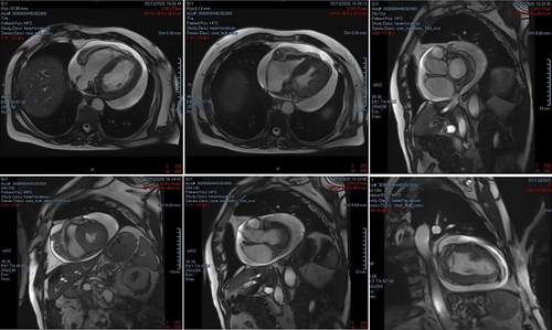 Figure 1 Cardiac magnetic resonance imaging in cine T2 sequences demonstrating the pericardial mass in different slices.