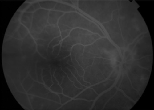 Figure 2 Fundus fluorescein angiography of the right eye in late phase shows no optic nerve head staining or leakage of dye in the macula.