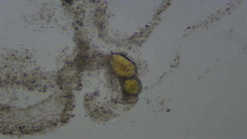 Figure 10 Glandular-shaped old white cell clumps and prostate calculi (magnified 200x under microscopy).