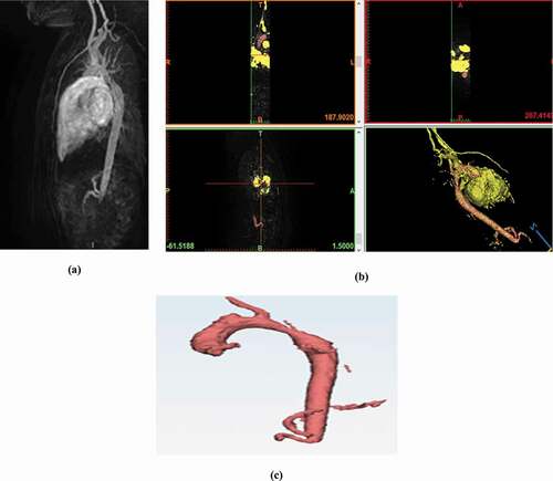 Figure 5. (a) original TRIKS cardiac sequences acquired with MRI;(bsteps of reconstruction and segmentation of the 3D aorta structure); (c) 3D reconstruction of the descending aorta