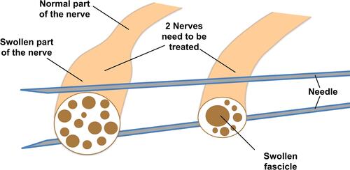 Figure 2 Illustration of two examples of abnormal nerves. The nerve on the left side has part of the nerve with the whole cross-sectional area (CSA) double, or even more, than normal, but the fascicles of the nerve are relatively normal. The nerve on the right side shows the CSA of the nerve is normal or slightly enlarged but one or more of the fascicles inside the nerve is much larger. The needles in this illustration will be referred to later to illustrate how method 1 can be used to hydrodissect two parallel nerves (such as tibial and fibular nerves at popliteal fossae).