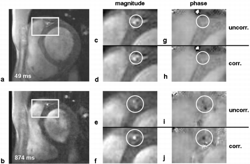 Figure 2. Anatomical images and velocity maps acquired 49ms and 874ms after ECG trigger. First heart phase: image quality is comparable for uncorrected (2c,2g) and corrected (2d,2h) data. Later heart phase: considerable improved image quality and vessel sharpness of the LAD (circles) is seen (2f,2j compared to 2e,2i).