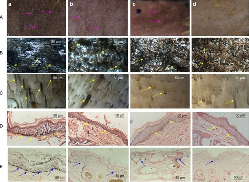Figure 6 Effects of the drug preparations on hyperpigmentation in guinea pig skin stimulated by 2 weeks of UVB radiation. (A) Photographs of the guinea pig skin appearance (obvious pigment indicated by purple arrows). (B) Microscopic appearance of the pigmented epidermis (obvious pigment indicated by yellow arrows). (C) Microscopic appearance of the pigmented dermis (obvious pigment indicated by yellow arrows). (D) Hematoxylin and eosin-stained images of pigmented skin sections (obvious pigment indicated by yellow arrows). (E) Fontana-Masson stain images of melanin in the epidermal layer (obvious melanin indicated by blue arrows). (a) Blank control, (b) group treated with salidroside-loaded hydrogel, (c) group treated with paeonol-loaded nanosphere dispersion, and (d) group treated with the sequential-release salidroside and paeonol nanosphere-gel.Abbreviation: UVB, ultraviolet B.