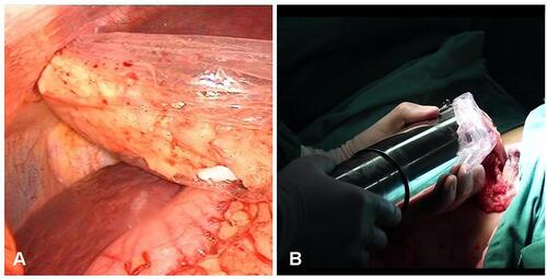 Figure 3 Withdrawing the omentum. (A) Part of the omentum is pulled out of the abdominal cavity through the laparoscopic sleeve. (B) The volume of the omentum is measured by the soft tissue measuring cylinder.