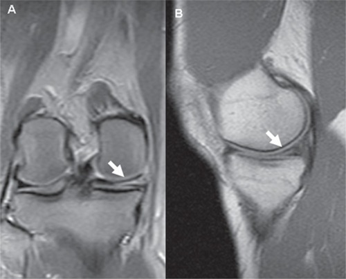 Figure 1 A) Coronal and B) Sagittal magnetic resonance imaging view of a medial meniscal tear in a knee without prior meniscal surgery.
