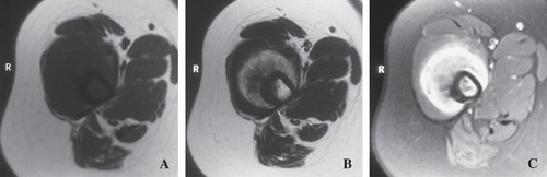 Figure 2.  Case1. (A) MRI revealed an isointense lesion within the quadriceps femoris muscle on T1-weighed images. (B) T2-weighed images showed a heterogenous hyperintense lesion. (C) The lesion was enhanced heterogeneously on fat-suppressed T1-weighed images after gadolinium injection.