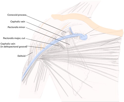 Figure 2. Anatomy of the cephalic arch [Citation10].