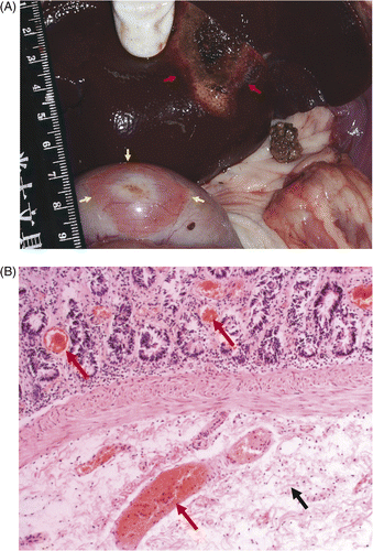 Figure 4. (A) The bowel was severely damaged in group A within one hour of microwave ablation. The damaged bowel wall (yellow arrow), the ablation liver (red arrow). (B) Histological examination showed tissue congestion (red arrow) and oedema (black arrow) in submucosa and mucosa in large bowel in group A within one hour of microwave ablation (HE × 200).