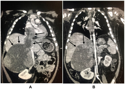 Figure 1 Comparison of abdominal CT before and after chemotherapy (the patient was a 2-year-old girl, the main complain was progressive aggravation of facial rash, the patient visited our hospital in January 2019, the clinical diagnosis was adrenal space occupying, the tumor was punctured and biopsied, ACC was confirmed by biopsy, chemotherapy was given first because of the intolerance to operation. (A) is abdominal CT at onset, the size of adrenal masses was 85 × 71 × 110mm, tumor thrombi in inferior vena cava could be seen. (B) indicates that the tumor shrank to 65 × 65 × 100mm after four cycles of chemotherapy, and the tumor thrombi in inferior vena cava were significantly reduced.) Decreased size of the adrenal cortex lesions of the same child in the same position after chemotherapy was indicated in arrows.