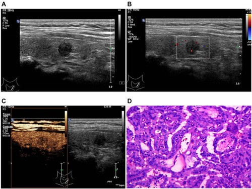 Figure 1 An 8mm papillary thyroid carcinoma without central cervical lymph node metastasis in a 55-year-old woman. (A) Gray-scale ultrasound shows a marked hypoechoic nodule in the left lobe of the thyroid, with a measurement of nodule size and a distance from the adjacent thyroid capsule. (B) Sparse intranodular and peripheral blood flow signal is found on color Doppler imaging. (C) On contrast-enhanced ultrasound, comparing with the normal thyroid parenchyma, the nodule shows inhomogeneous hypo-enhancement, with clear enhanced border, no ring enhancement, and no extrathyroidal extension. (D) Papillary thyroid carcinoma was confirmed by pathology (hematoxylin-eosin stain, ×400 magnification).