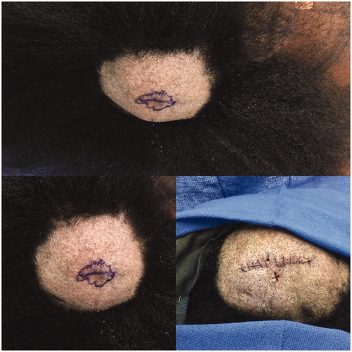 Figure 1. Top: Right posterior parietal scalp with skin lesion. Bottom left: Closer-up view of lesion and scalp. Bottom right: Post-excision as well as showing inferior biopsy site.