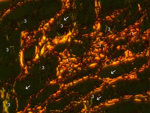 Figure 15 Polarized PSR (200×). Collagen-I stained orange-red (1) and Collagen-III stained green-yellow. Fine green lines (3) of Collagen-III are shown to be in contact with CaHA particles (white arrows).