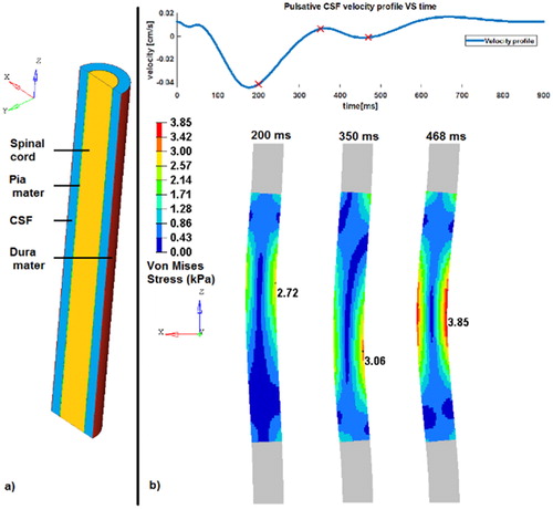 Figure 1. a) the different model parts (left). b) Von Mises stress (MPa) generated by the CSF flow (top) on the spinal cord at 3 different times (red markers on the velocity profile) corresponding to local maximum. The magnitude of the displacement is exaggerated by a factor 4 for visualization (right).
