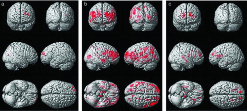 Figure 1.  Results of the voxel-wise comparisons of FA maps among the three subject groups of cognitive normal, moderate chronic obstructive pulmonary disease (COPD), and severe COPD. Maps are superimposed on a three-dimensional surface rendering of a template brain (upper left: anterior view; upper right: posterior view, middle: lateral views, lower left: inferior view, lower right: superior view). The red color indicates a statistically significant difference in FA (false discovery rate lower than 5%, one-way ANOVA). A. Results from the comparison between the moderate COPD patient and the control group (Normal > Moderate COPD). B. Results from the comparison between the severe COPD patient and the control group (Normal > Severe COPD). C. Results from the comparison between the severe and moderate COPD patient group (Moderate COPD > Severe COPD).