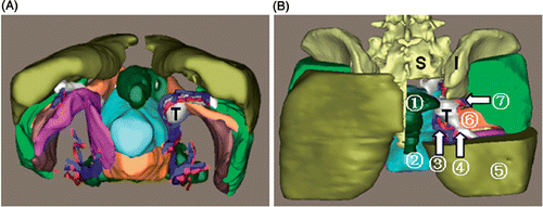 Figure 7. 3D reconstruction of the tumor region for patient 3. (A) Tumor and peritumoral muscles and vessels: “T” indicates the tumor. (B) Posterior view with some structures cut away to show the spatial relationships between the tumor and peritumoral structures: (1) rectum; (2) uterus; (3) inferior gluteal vessels; (4) sciatic nerve; (5) gluteus maximus; (6) piriformis; (7) superior gluteal vessels. “S” indicates the sacrum, “I” the ilium. The visualized information offered by the 3D model of the tumor region can facilitate the preoperative assessment.