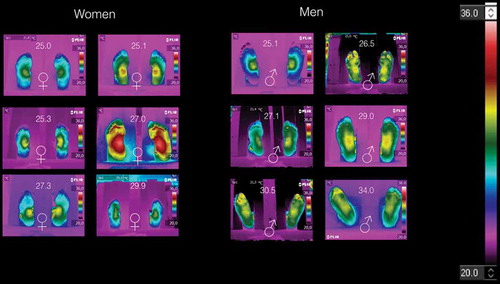 Figure 3. Thermograms of volunteers with BMI ≥ 25 kg/m2. It is not possible to distinguish women thermograms from those of men thermograms. However, symmetry is observed in some of these thermograms. The temperature distribution is still decreasing from the middle to the periphery of the foot.