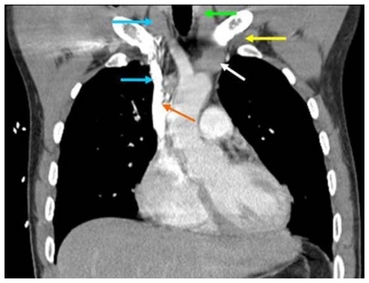 Figure 2 Computed tomography scan showing venous course from right internal jugular vein (blue arrows) and venous course from left subclavian vein (yellow arrow) through the innominate vein (white arrow) to superior vena cava (orange arrow); course from left internal jugular vein (green arrow) with turns at junctions with innominate vein and superior vena cava.