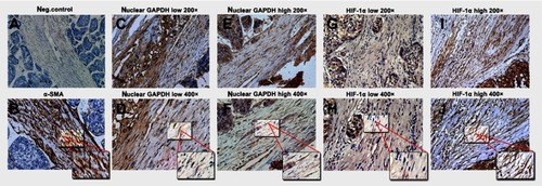 Figure 3 Immunohistochemical staining for α-SMA, nuclear GAPDH, and HIF-1α in HCC tissues containing HSCs. (A) α-SMA staining in the negative control and HSCs (B) in HCC tissues. (C–F) Different nuclear GAPDH expression patterns in HSCs within HCC tissues. (G–J) Different HIF-1α expression patterns in HSCs within HCC tissues. (A, C, E, G, and I: 200× magnification; B, D, F, H, and J: 400× magnification).Abbreviations: GAPDH,  glyceraldehyde-3-phosphate dehydrogenase; α-SMA, α-smooth muscle actin; HIF-1α, hypoxia-inducible factor 1α; HCC, hepatocellular carcinoma; HSCs, Hepatic stellate cells.