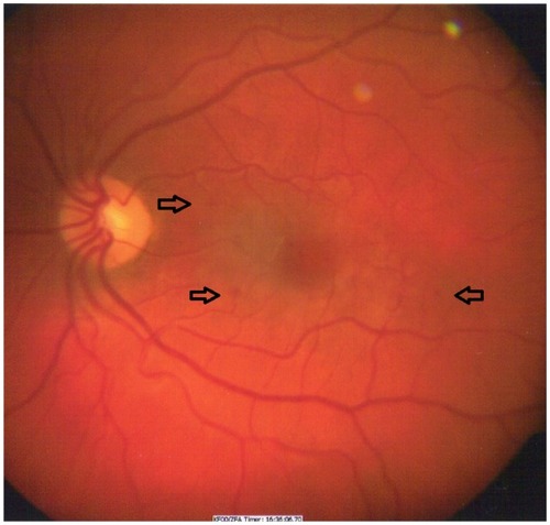 Figure 1 Left macula with dull foveal reflex and a few hemorrhages are indicated by arrows.