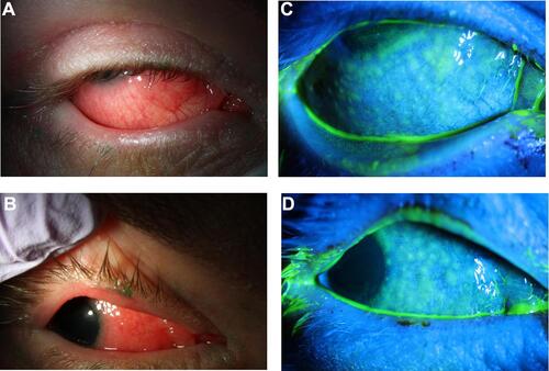 Figure 1 (A and B) Slit lamp photography demonstrates thickening of lid margins, follicular reaction, and diffuse conjunctival injection. (C and D) With fluorescein instillation, negative staining reveals bulbar conjunctival follicular elevation.